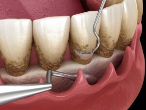 Подробнее о статье Как удалить зубной камень