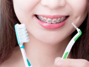 Подробнее о статье Уход за зубами после установки брекет-систем