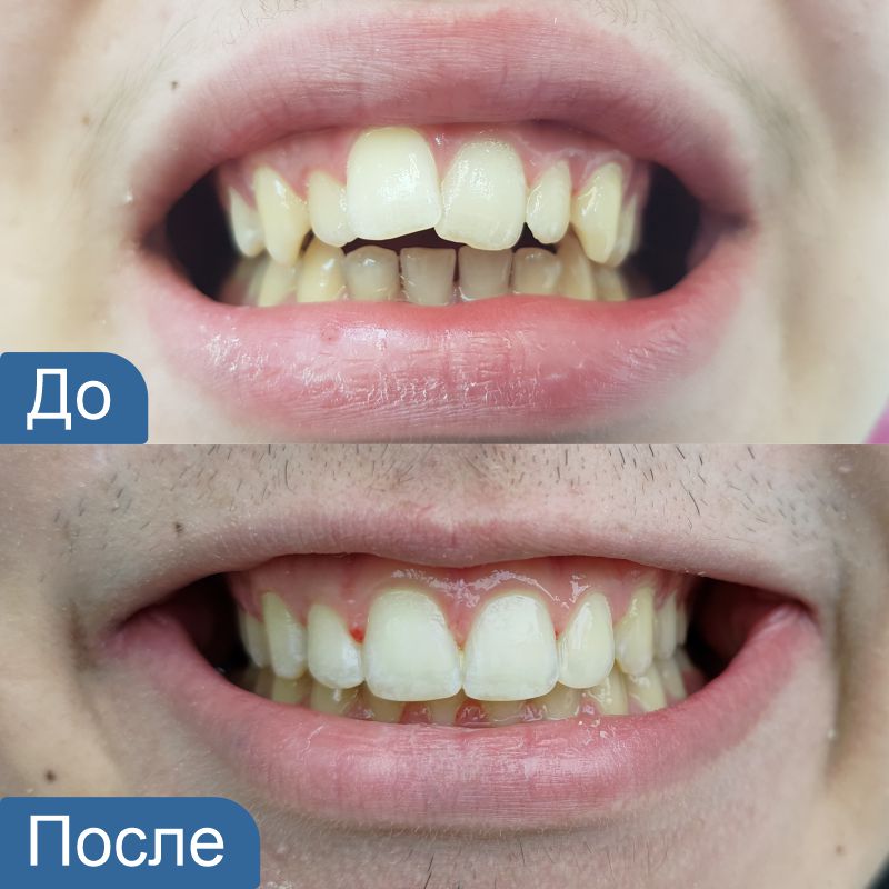 Расширение зубного ряда