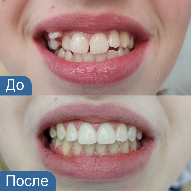 Выравнивание зубов